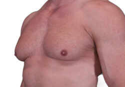 Male Breast Reduction