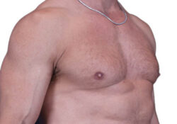 Male Breast Reduction
