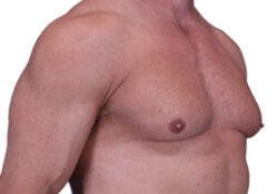 Male Breast Reduction