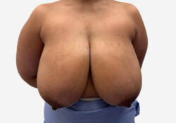 Breast Reduction