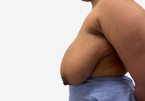 Breast Reduction