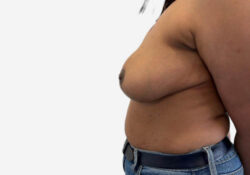 Breast Reduction