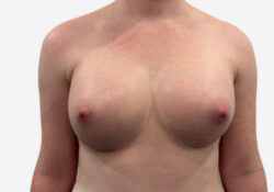 Breast Augmentation