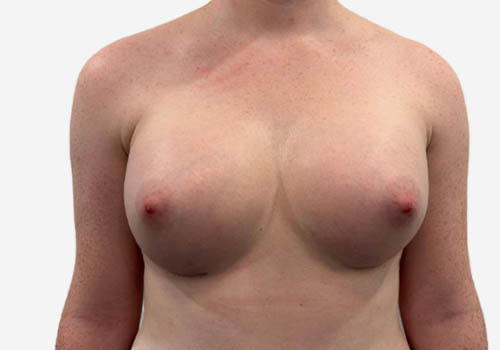 Breast Augmentation
