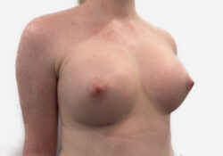 Breast Augmentation