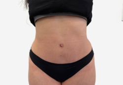 Tummy Tuck