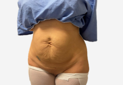 Tummy Tuck