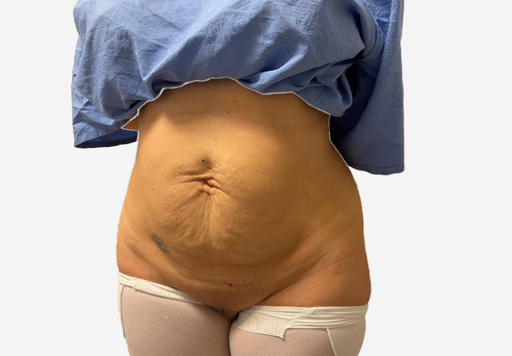 Tummy Tuck