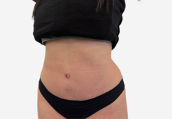Tummy Tuck