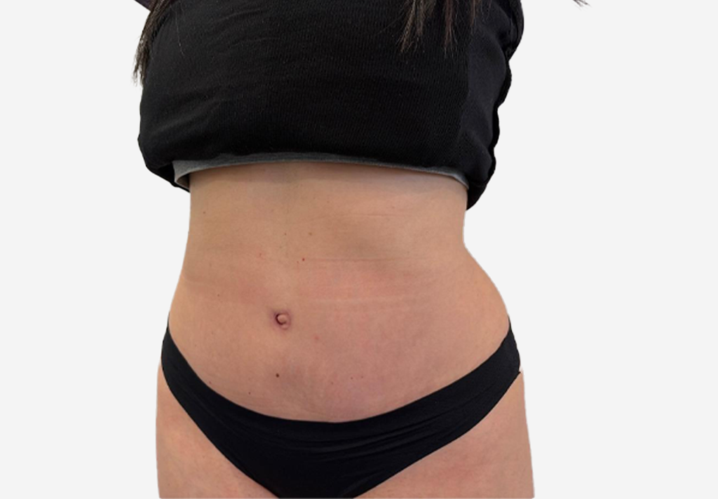Tummy Tuck