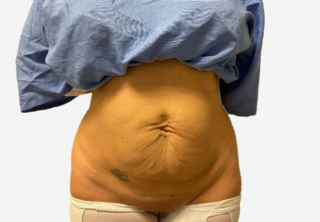 Tummy Tuck