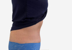 Tummy Tuck