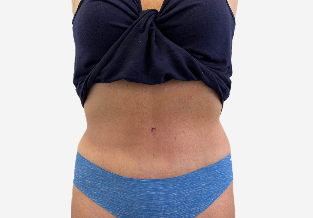 Tummy Tuck