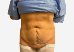 Tummy Tuck