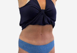 Tummy Tuck