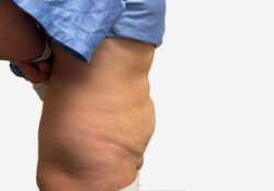 Tummy Tuck