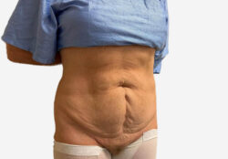Tummy Tuck