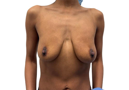Breast Augmentation