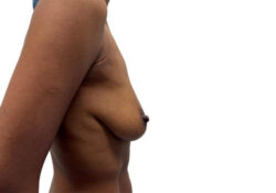 Breast Augmentation