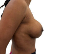 Breast Augmentation
