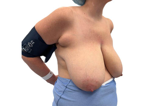 Breast Reduction