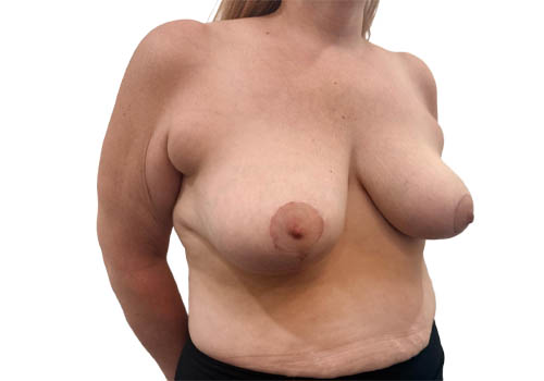 Breast Reduction
