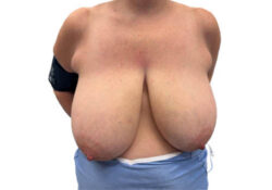 Breast Reduction