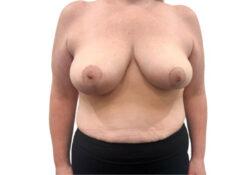 Breast Reduction