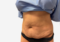 Tummy Tuck