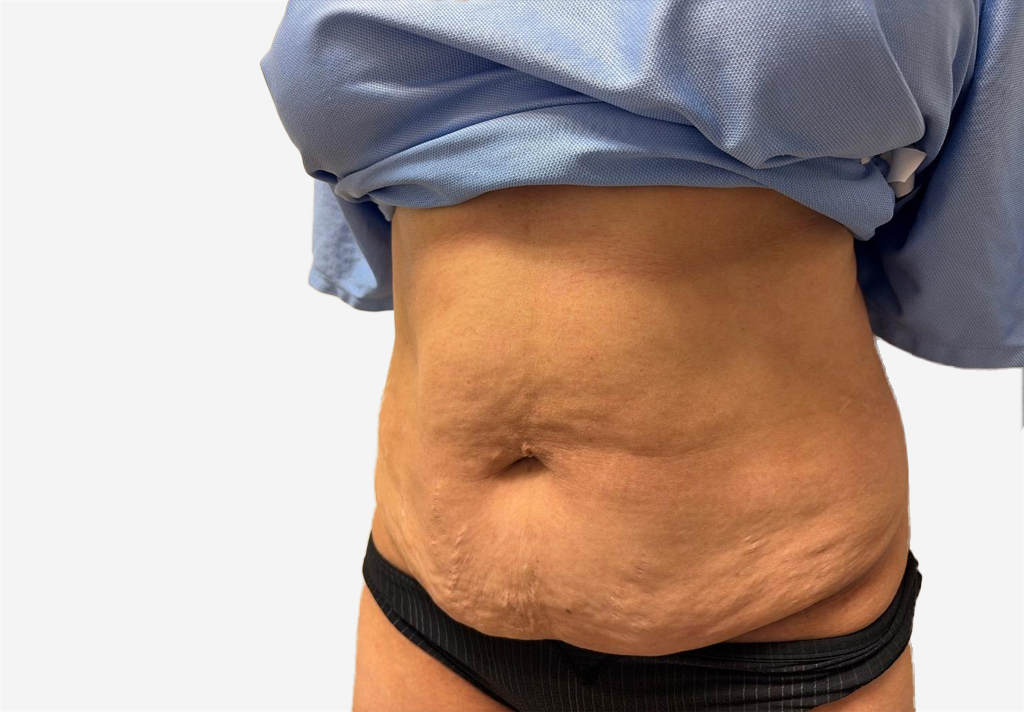 Tummy Tuck