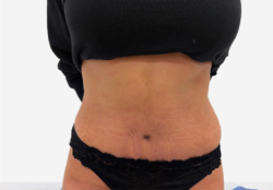 Tummy Tuck