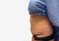 Tummy Tuck