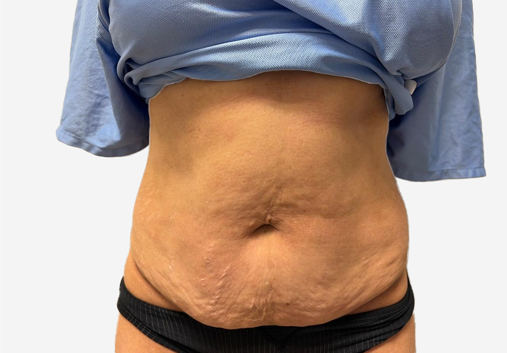 Tummy Tuck