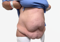 Tummy Tuck