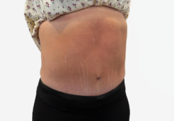 Tummy Tuck