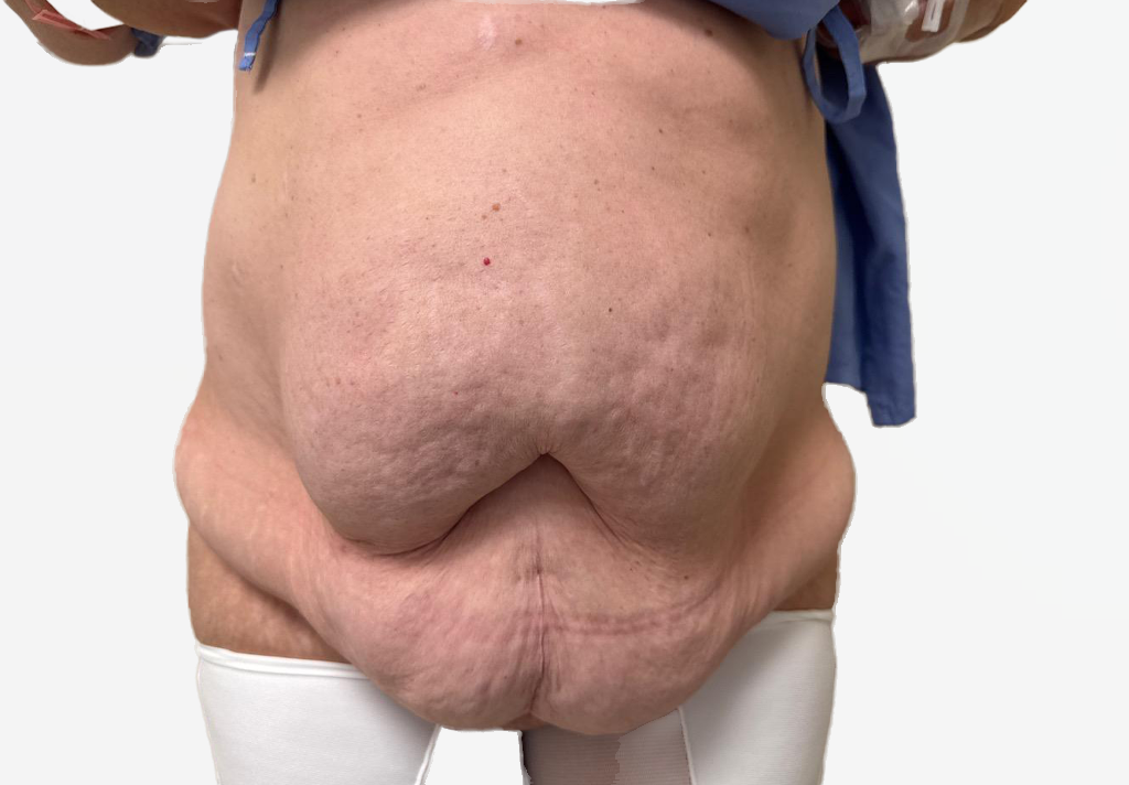 Tummy Tuck