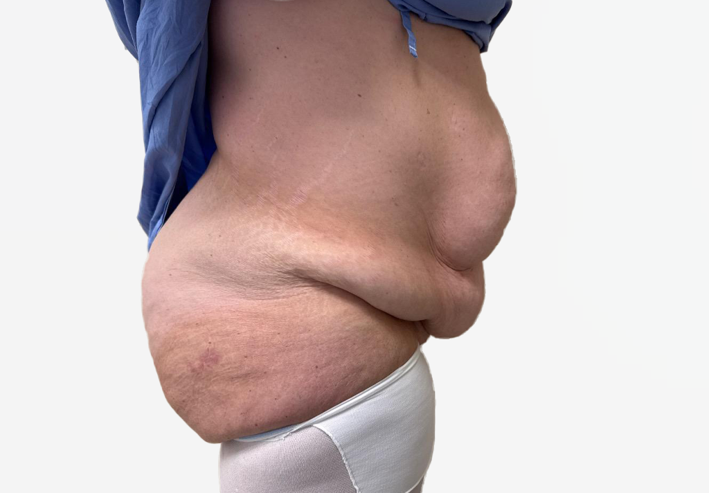 Tummy Tuck