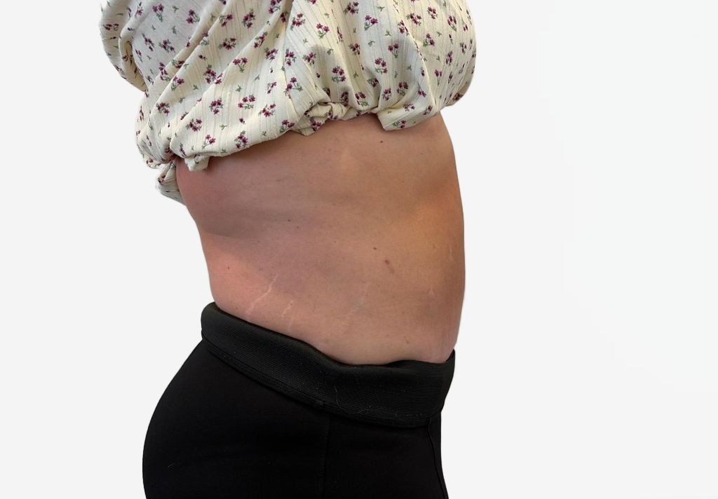 Tummy Tuck