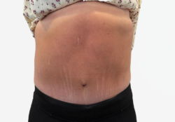 Tummy Tuck
