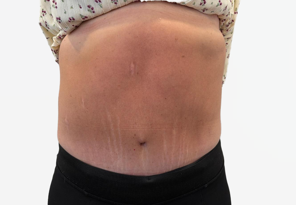 Tummy Tuck