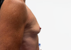Breast Augmentation