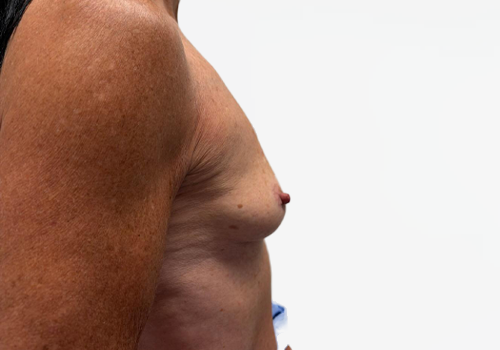 Breast Augmentation