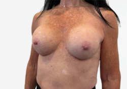 Breast Augmentation