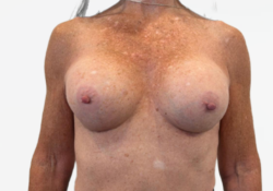 Breast Augmentation