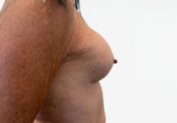 Breast Augmentation