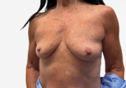 Breast Augmentation