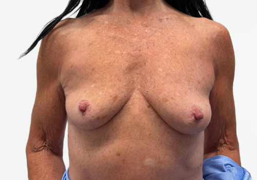 Breast Augmentation