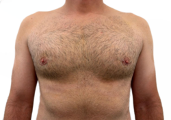 Male Breast Reduction