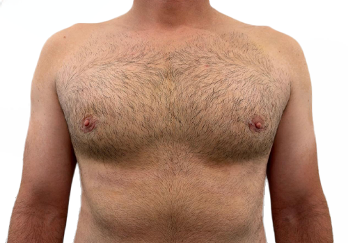 Male Breast Reduction
