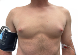 Male Breast Reduction